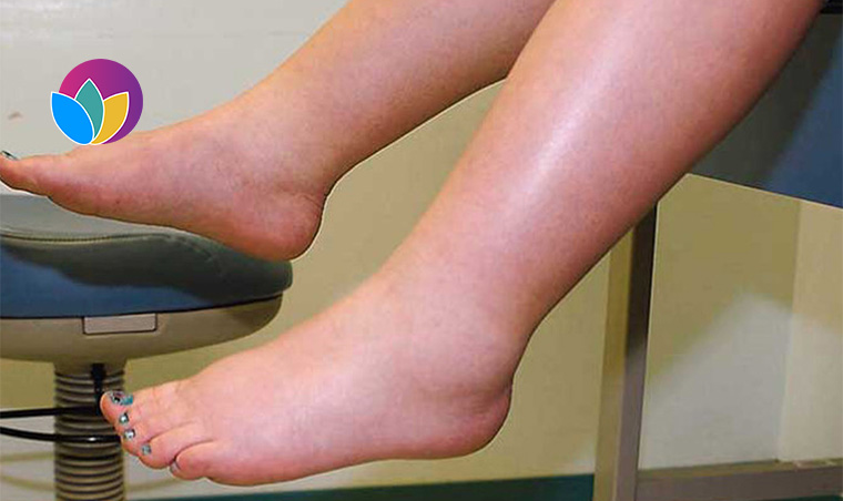 Fluid Retention Treatment丨Reduce Water Retention & Maintain Healthy Fluid Levels