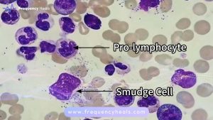 Chronic Lymphocytic Leukemia