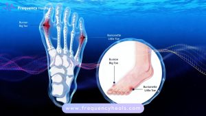 Bunions