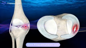 Torn Meniscus Support