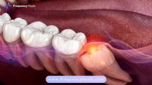 wisdom tooth pain relief