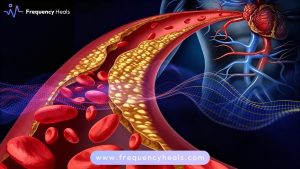 Arteriosclerosis Support