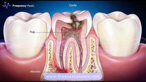 Dental Abscess Support