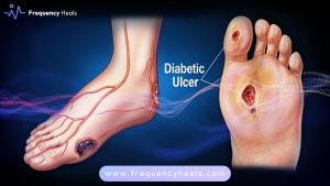 Diabetic Foot Support