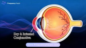 Dry Eye Support