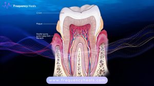 Periodontitis Support Frequencies