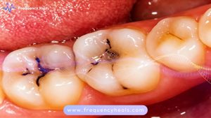 Tooth Decay Support