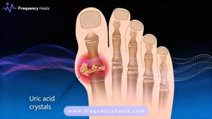 High Uric Acid