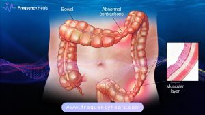 Irritable Bowel Syndrome