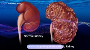 Polycystic Kidney Support