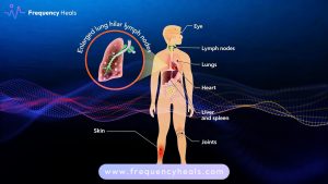 Sarcoidosis Support