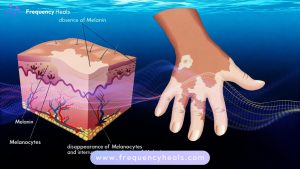 Vitiligo Support