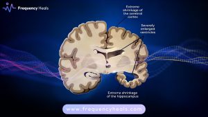 Dementia Support