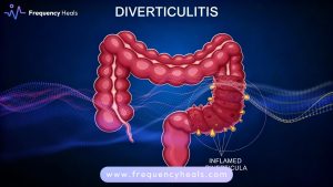 Diverticulosis Support