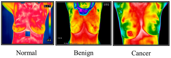 Examples of breast thermograms