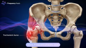 Hip Bursitis