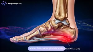 Plantar Fasciitis Support