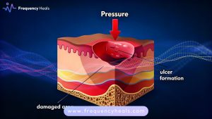 Ulcer Relief
